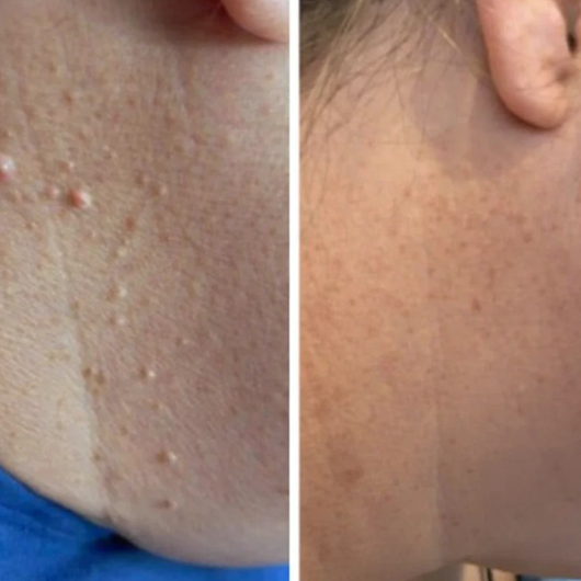 Velura - Piel suave en sólo 4 días